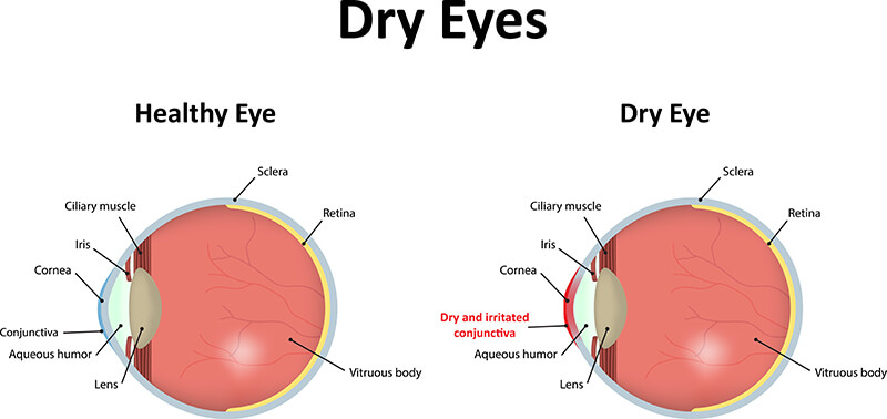 Dry Eye Comparison Diagram Healthy Vs Dry Eye