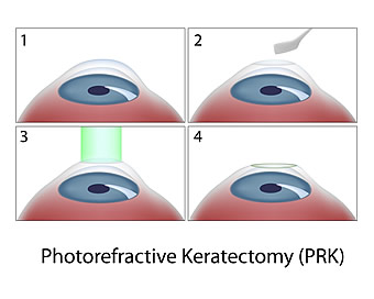 Phototrefreactive Keratectomy (PRK) Surgery Steps Diagram