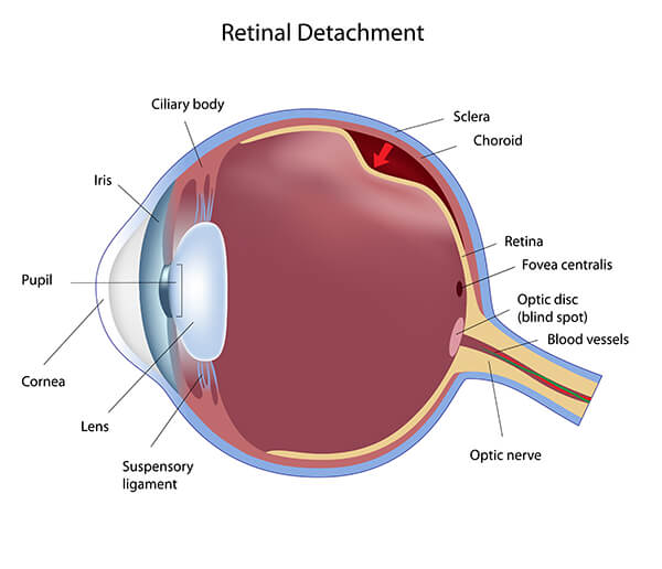 Retinal Detachment Diagram and Anatomy